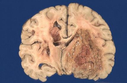 cancer-brain